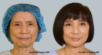 55-64 yo woman treated with Facelift, Endoscopic Browlift, Chin Augmentation, Fat Transfer, Picosure - 55-64 yo female 4 months s/p Face and Neck Lift, Endoscopic Browlift, Chin Augmentation, Fat transfer & Picosure for treatment of dark spots.