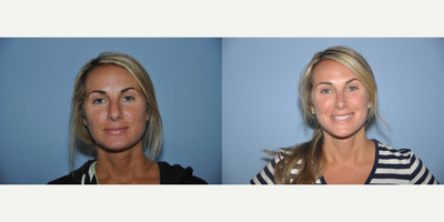 25-34 year old woman treated with Rhinoplasty - This 32 year old woman had a Rhinoplasty. (Nose Surgery)