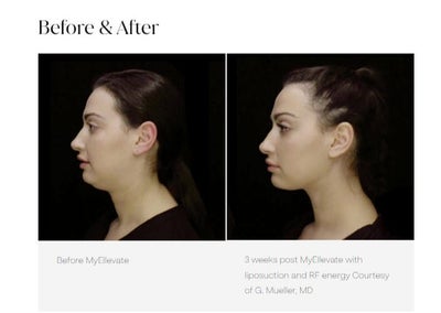 25-34 year old woman treated with MyEllevate - 3 weeks post MyEllevate with liposuction and RF energy