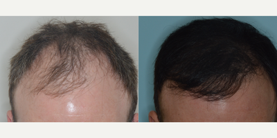 35 year old man treated with Hair Transplant to the frontal scalp - Before and 1 year after 1880 FUE grafts to frontal scalp in a 35 year old male patient.