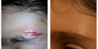 Woman treated with Facial Reconstructive Surgery - Woman treated with Facial Reconstructive Surgery