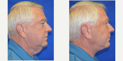 55-64 year old man treated with Cheek Augmentation - This gentleman came in wanting to correct the sagging skin at his neck and jowls and add natural volume to his face. After visiting with Dr. Ho, the patient elected to have a face/neck lift and cheek implants.