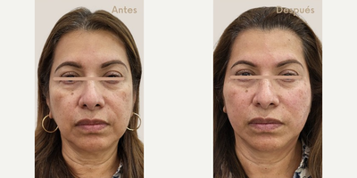 Woman treated with Nonsurgical Facelift - Woman treated with Nonsurgical Facelift
