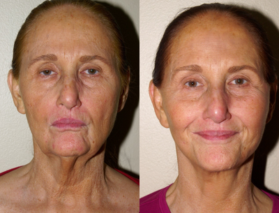 65-74 year old woman treated with Facelift - This patient was 72 years old and in good physical health at the time of her procedure. Her jawline and neckline improved significantly with the removal of fatty tissue and the softening of muscle bands. The entire process was carried out under a local anesthetic with sedation and performed as an outpatient. Most people do opt to recover in the comfort of their own home. Arrangements can always be made for a visiting nurse if one is desired.