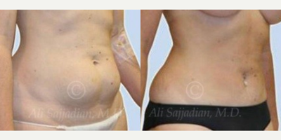 Woman treated with Mini Tummy Tuck - Mini Tummy Tuck