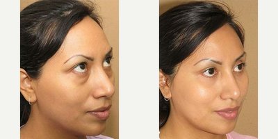Woman treated with Eyelid Surgery - Woman treated with Eyelid Surgery