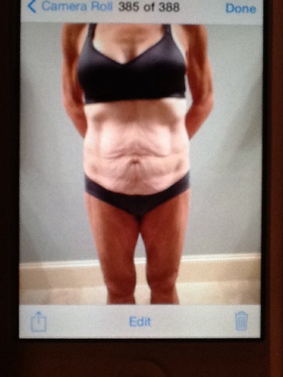 saggy skin loss weight massive lift lots realself