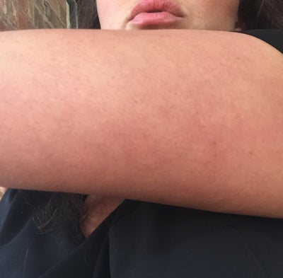 Dry Red Patch On Upper Arm