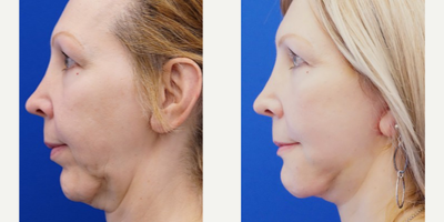 55-64 year old woman treated with Chin Implant - She is born with facial asymmetry and suffers from lower face deformity from previous chin implant surgery. Staged surgery restores facial proportion which includes revision chin implant, mini lift.