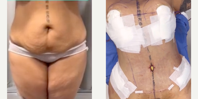 Woman treated with Tummy Tuck - Woman treated with Tummy Tuck