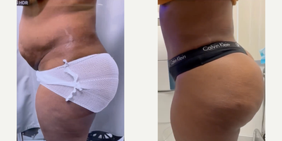 Woman treated with Tummy Tuck - Woman treated with Tummy Tuck