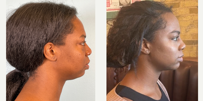 35-44 year old woman treated with Buccal Fat Removal, Jawline Sculpting, Chin Implant, Facial Fat Transfer - The CHEEKAGO!!