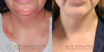 35-44 year old woman treated with Laser Liposuction - This patient tried and exhausted all non invasive options, including trying coolsculpt and kybella, with no results. She came to me and I recommended laser liposculpture. Here she is 2 years later on follow-up view.
