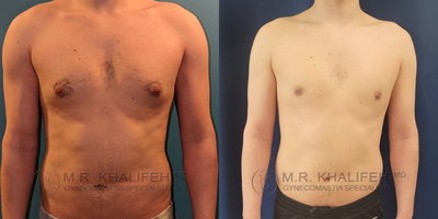 Man treated with Gynecomastia Surgery - Man treated with Gynecomastia Surgery