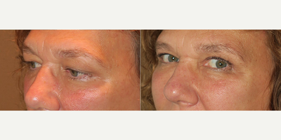 Woman treated with Eyelid Surgery - Woman treated with Eyelid Surgery