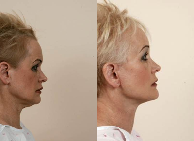 63 year old female treated for facial aging - This 63 year old female wanted a natural appearing facial rejuvenation. She underwent a facelift and endoscopic forehead lift. 