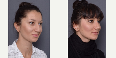 28 year old female treated with Rhinoplasty - A 28 year old female who underwent a rhinoplasty.