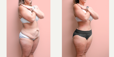 35-44 year old woman treated with Liposuction, Tummy Tuck - This patient lost significant weight through diet and exercise but this resulted in sagging skin and an underwhelming result after all her efforts. She is shown here 2 months post-op from 360 Lipo suction and abdominoplasty. She was able to achieve a snatched shape and amazing curves which complimented her flat abdomen.