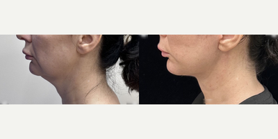 Woman treated with Facelift - Woman treated with Facelift