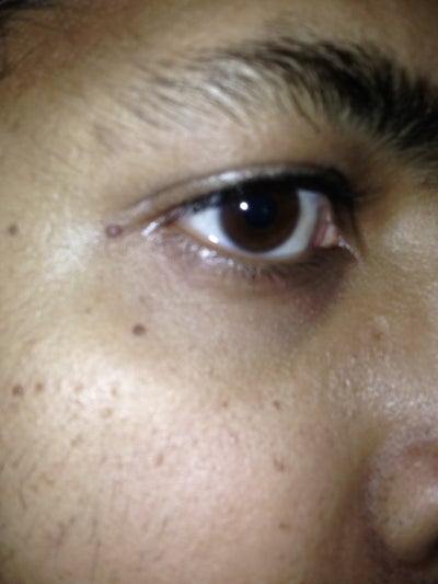 dark-brown-spots-near-and-below-eyes-doctor-answers-tips