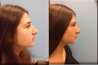18-24 year old woman treated with Rhinoplasty - 18 yr old female with a crooked nose and hump from previous trauma. Underwent Septo rhinoplasty with minimal pain. Here she is after one month