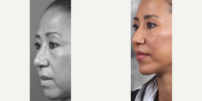 Woman treated with Eyelid Surgery, Deep Plane Facelift, Facial Fat Transfer, Lip Lift, Chin Implant - .- Blepharoplasty: Brightening and rejuvenating the eyes..- Deep Plane Mini Lift: Refining facial contours with elegance..- Fat Injections: Restoring youthful fullness and vitality..- Lip Lift: Perfectly enhancing the smile..- Chin Implant: Sculpting a harmonious, balanced profile.Surgery by Dr. James Marotta