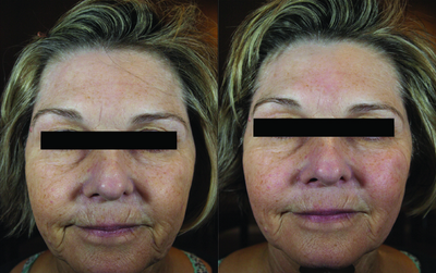 Venus Legacy - Before and After 5 Treatments.Photos provided courtesy of Venus Concept, performed by Victoria Smithers, MD.