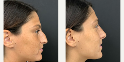 Woman treated with Rhinoplasty - Rhinoplasty