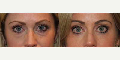 45-54 year old woman treated with Eyelid Surgery - lower blepharoplasty