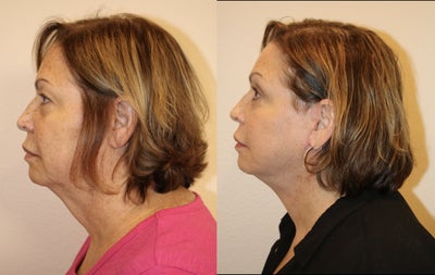 55-64 year old woman treated with Facelift - This is a 63-year-old woman who underwent a lower face and neck lift and also a Bilateral upper eyelid blepharoplasty. The after photos are shown five weeks following surgery.