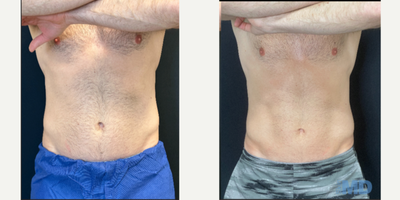 25-34 year old man treated with Emsculpt - This patient has received 6 sessions of Emsculpt NEO at the time of photos. He is so pleased he is continuing with us on our Medical Gym Membership program. Emsculpt NEO supports an active lifestyle helping our patients achieve their own personal fitness goals!