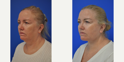 55-64 year old woman treated with Facelift, Chin Liposuction - She had no wrinkles but her full neck made her look a lot older than her 55 years! Dr Pautler did a lower face and neck lift on her and now she has a youthful jawline and younger appearance.