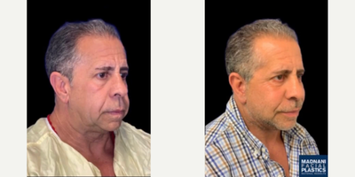 55-64 year old man treated with Facelift - Deep Planeface lift under oral sedation