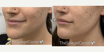 25-34 year old transgender woman treated with Jaw Surgery - 25-34 year old transgender woman treated with Jaw Surgery