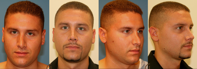 Revision Rhinoplasty -
This patient had previous rhinoplasty and was not happy with the shape of his nose. Performed a revision rhinoplasty for him. 