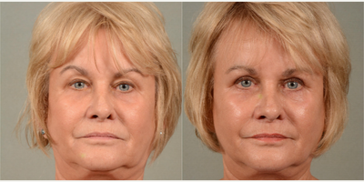 65-74 year old woman treated with Eyelid Surgery - Upper eyelid surgery and browpexy