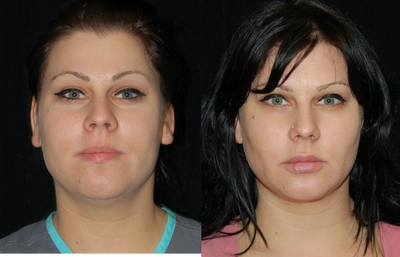 Cheek Fat Pad Removal - 32 year old female that underwent a buccal lipectomy and liposuction of the neck