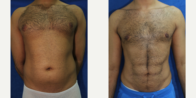 25-34 year old man treated with Male Breast Reduction - This patient was dissatisfied with his upper chest because of his gynecomastia. He desired a flat chest. This patient underwent VASER Hi-Def Liposuction of the chest to achieve his desired results.
