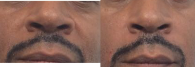 45-54 year old man treated with Cheek Lift with restylane - This gentleman did not like his nasolabial cheek folds. We augmented his cheeks with restylane. He responded very well!