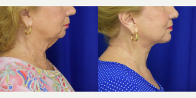 2209 75 and up year old woman treated with Facelift, Chin Implant - 2209 75 and up year old woman treated with Facelift, Chin Implant