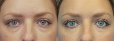 25-34 year old woman treated with Restylane - This patient wanted to decrease the appearance of under eye bags. She was treated with Restylane to the tear trough.