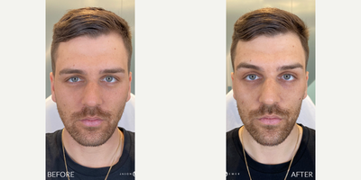 FACIAL SCULPTING + BOTOX REFRESHER - Our patient came to us because he heard we were the best around at facial sculpting and botox. He already has great facial structure, so we accentuated his sharp features with the help of filler at key areas like his chin, temples, cheeks, and jawline. Additionally, with the help of botox he wanted to reverse signs of aging he's beginning to notice- specifically his crow's feet and 11 lines. We gave him a more defined jawline, contoured cheeks, a balanced chin, lifted his brows, plus stopped his crow's feet and 11 lines from forming. Needless to say, he absolutely loves his refreshing results and newly sculpted features.YOUR OWN TRANSFORMATION IS CALLING. ARE YOU GOING TO ANSWER?