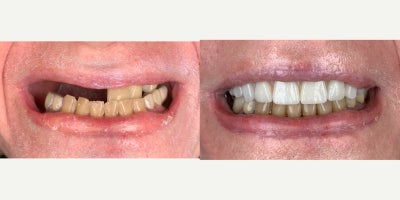 75 and up year old man treated with Dental Implants, All-on-4 Dental Implants, Dental Bone Graft - Years of broken upper teeth had taken his confidence. Eating was difficult and smiling felt impossible. When he came to us, he just wanted to chew again without pain. We created a plandental implants to restore strength, rebuild his bite, and bring back what time had broken down.