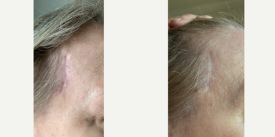 Patient treated with Scar Removal - Temporal Scar Removal - 55 to 64 year-old female patient is 1.5 years post-op from Scar Removal surgery. Her procedure was: Temporal Scar Removal.