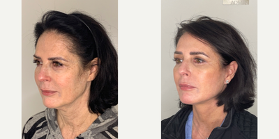 55-64 year old woman treated with Facelift, Neck Lift, Eyelid Surgery, Facial Fat Transfer, CO2 Laser - 58 year old patient 3 months after Facelift, Neck lift, Upper Eyelid Blepharoplasty, Fat Transfer and CO2 laser.
