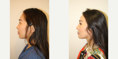 25-34 year old woman treated with Chin Implant - This female patient is shown before and after chin implant surgery. An intraoral route of insertion was used. A size small Implantech silicone implant was placed and secured with 2 titanium screws.