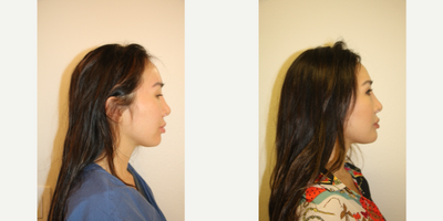 25-34 year old woman treated with Chin Implant - This female patient is shown before and after chin implant surgery. An intraoral route of insertion was used. A size small Implantech silicone implant was placed and secured with 2 titanium screws.