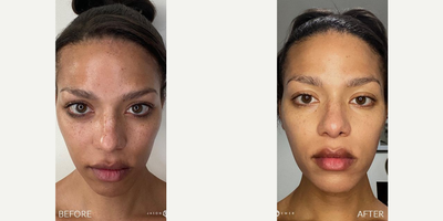 Woman treated with Microneedling - Woman treated with Microneedling