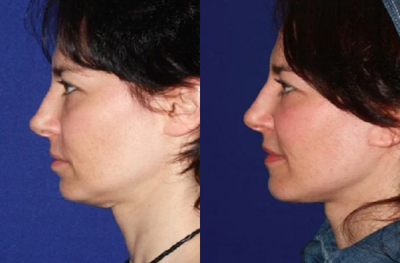 35-44 year old woman treated with Mini Facelift - This patient presented for a mini facelift. She was concerned with early aging changes including the jowls and some loose skin under the chin. Early aging changes were reversed with her rejuvenation procedure.
