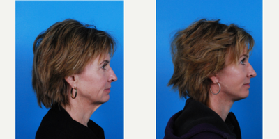 54 year old woman treated with Facelift - The doctor performed a facelift on this 54 year old woman who was wanting a natural looking result.